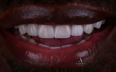 Amira Aesthetics | Dentures, Botox reg  and Dental Fillings
