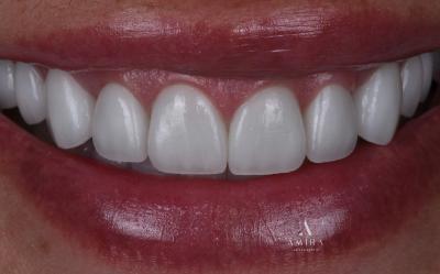 Amira Aesthetics | Dental Fillings, Veneers and CEREC reg  Crowns