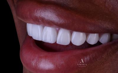 Amira Aesthetics | Invisalign reg , Dental Bridges and Dental Fillings
