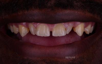 Amira Aesthetics | Six Month Smiles reg , Oral Exams and CEREC reg  Crowns