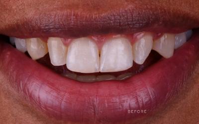 Amira Aesthetics | Orthodontics, Root Canals and CEREC reg  Crowns