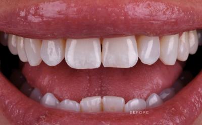 Amira Aesthetics | Preventative Program, Invisalign reg  and Botox reg 